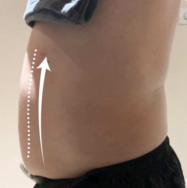 After Bye bye Big Belly treatment