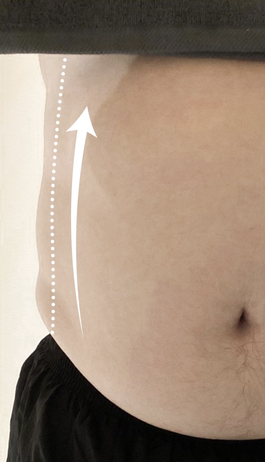 After Smaller Belly, Bigger Confidence treatment