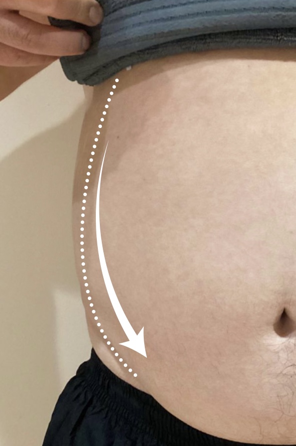 Before Smaller Belly, Bigger Confidence treatment