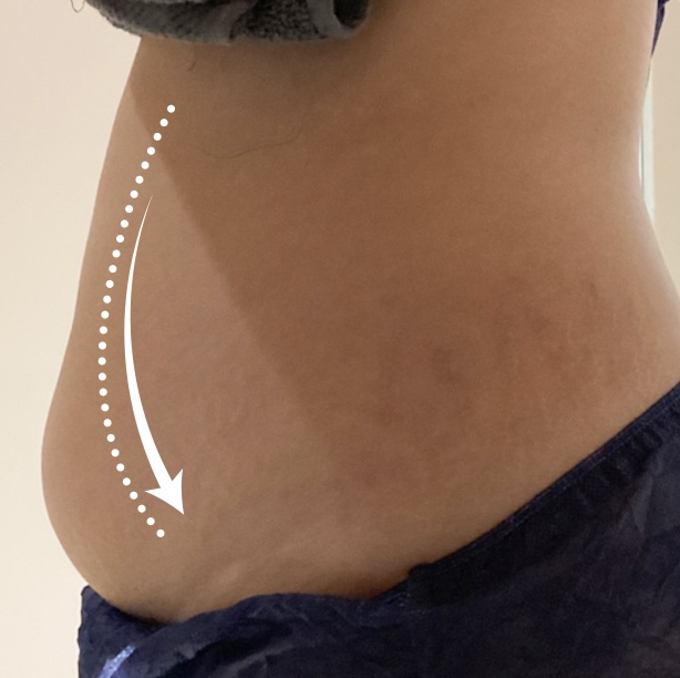 Before Lost 5kg in 2 months treatment